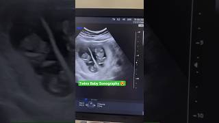 #ultrasound Twins Baby Sonography #gynaecologist #pregnancy #sonography #twins #twinsbaby