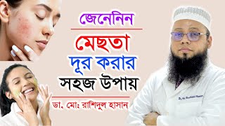 মেছতা দূর করার সহজ উপায় | DR.MD. Rashidul Hasan | Melasma Treatment Bangla Tips | Doctor Tube