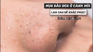 Seri nặn mụn-Part 36 Đối thủ nặng ký của mụn liên quân đây rồi