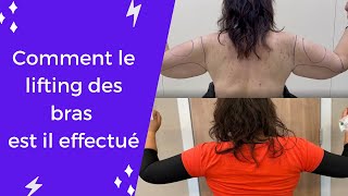 Comment le lifting des bras est il effectué