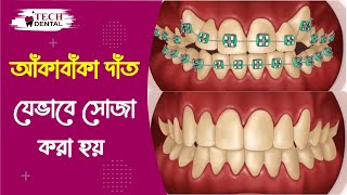 আঁকাবাঁকা দাঁত যেভাবে সোজা করবেন ।। How to straighten crooked your teeth ll Tech Dental