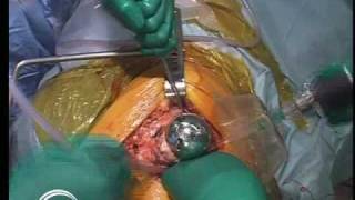 Birmingham Hip Resurfacing (BHR) Surgery by Derek McMinn (Part 5)