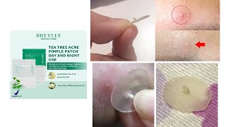 Acne patch bening untuk mengangkat jerawat bernanah