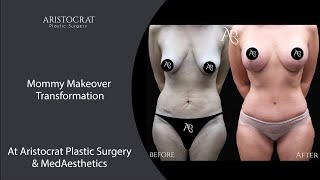 Mommy Makeover Surgery: Breast Lift with Ideal Implants, Tummy Tuck & Lipo of Flanks