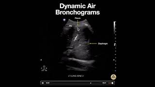 Dynamic Air Bronchograms in Lobar Pneumonia