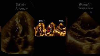 Have you seen ‘BICUSPID’ tricuspid valve. Here it is with Ebstein anomaly.