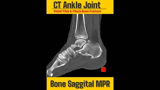 #RADIOLOGY SHORTS /ANKLE JOINT / TIBIA & FIBULA BONE DISTAL FRACTURES/BONE SAGGITAL  MPR.