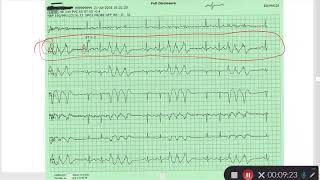 EKG Review Part 2