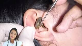 Dr.Natacha, satisfying vidéo earwax removal, earclining.