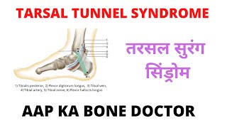 TARSAL TUNNEL SYNDROME - EPISODE 34