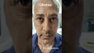 Conoce como eliminamos ojeras estructurales #avefenixestetic