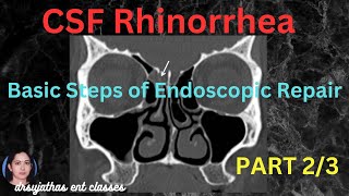 235.CSF  Rhinorrhea Part 2/3 -CSF Rhinorrhea Treatment #surgeryeducation #dentallectures