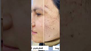 Reduction of skin hyperpigmentations and moles. #skincare