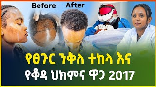 የፀጉር ንቅለ ተከላና የቆዳ ህክምና ዋጋ 2017 | Hair transplant price in Ethiopia |Skin treatment | Gebeya Media