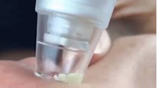 Blackhead Pore Cleansing Cleaner Removal