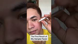 The vampier result facial treatment   #beauty #beautytips #vampire #treatment #result #youtubeshorts