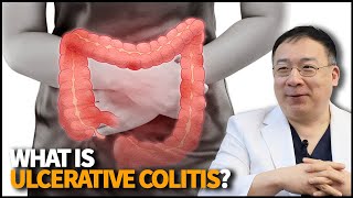 What is Ulcerative Colitis? Why is this chronic disease diagnosis can be scary?