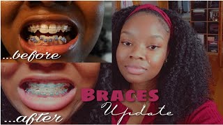 Adult Braces Journey Update | rubberbands, power chains, midlines, getting them off?