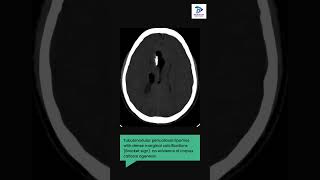 Neuroradiology Quiz case level 1 # Headache CT # Incidental brain abnormalities