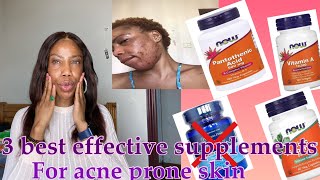 How to treat acne prone skin with 3 effective supplements for acne’s #zincpicolinate#acne#Ruchi Ata