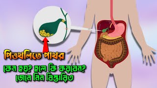 পিত্তথলিতে পাথর? @DoctorsTips থেকে জেনে থেকে বিস্তারিত