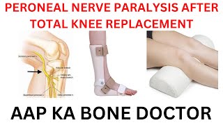 PERONEAL NERVE PALSY AFTER KNEE REPLACEMENT - EPISODE 27