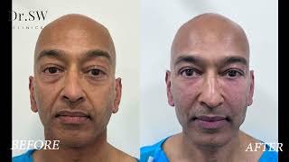 Amir's Fat Transfer to Face Before and After Treatment | Non-Surgical Testimonial | Dr SW Clinics