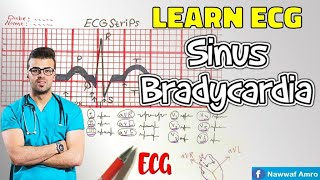 راجع معلوماتك بالإيقاع المتباطئ للقلب Learn ECG! Sinus Bradycardia