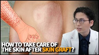 How to take care of the skin after Skin Grafting (Skin Transplant)? Who can be a donor for skin?