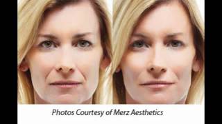 Santa Monica Botox, Restylane, Radiesse, Juvederm