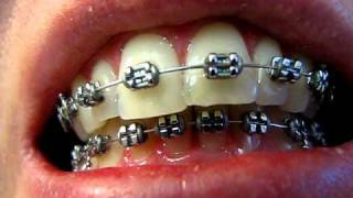 My Braces