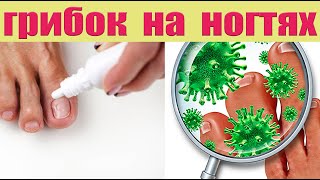 Рецепт от грибка на ногтях ног и рук