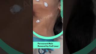 Permanent Mole Removal By CO2 Laser | Dr.Arif Iqbal@DrArifMDDermatologist #shorts #skin #treatment #mole