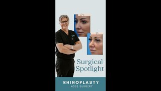 Dr. Mark Beaty, Atlanta Facial Plastic surgeon, shows his patient's rhinoplasty results.