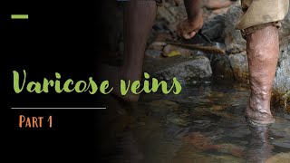 Varicose Veins | General Surgery | Part 1