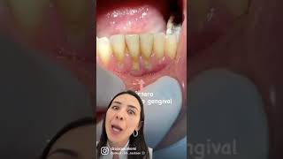 Limpeza dental. Será que é o seu caso?  Dra Jaque Akemi Londrina PR