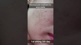 Black Chemical peel for acne marks