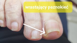 wrastanie paznokcia @podopogotowie boli paznokieć i co dalej ? #podologia #ingrown_toenail