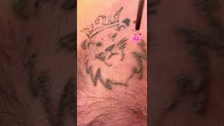 Laser tattoo removal on a chest tattoo