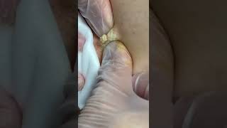 Blackheads big