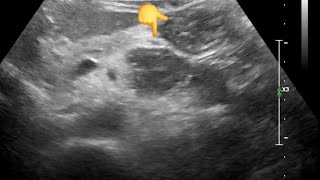 Diagnostic dilemma, Pancreatic Lesion: Jejunal Loop Mimicking Cancer on Ultrasound – CT Clarifies