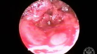 endoscopic-vein-harvest.mpg