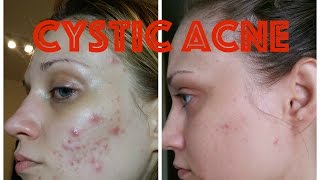 Cystic Acne - How I got rid of it!