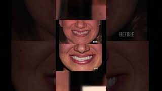 Underbite Correction without Jaw Surgery