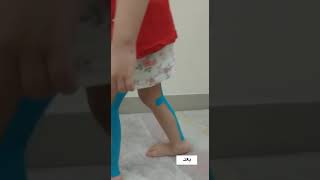 استخدام الشرائط اللاصقة hyperextension knee #kintap kintap#cerebralpalsy