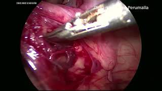 Laparoscopic Right orchidopexy for Intra abdominal testes in a 16 months infant