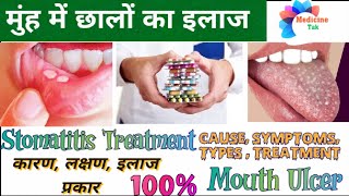 बार बार मुंह में छाले क्यों होते हैं ? Mouth Ulcer Treatment| Stomatitis Treatment In Hindi|Medicine