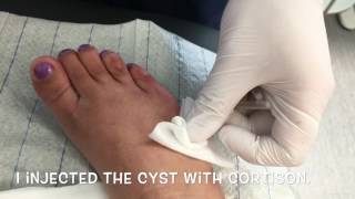 Ganglion Cyst Removal