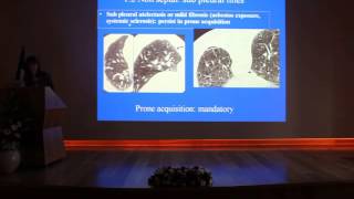 Infiltrative Lung Diseases - Marie Pierre REVEL