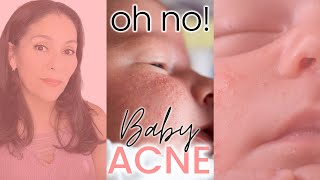 Newborn Baby Acne: Not So Perfect Baby Skin #newborn #shorts